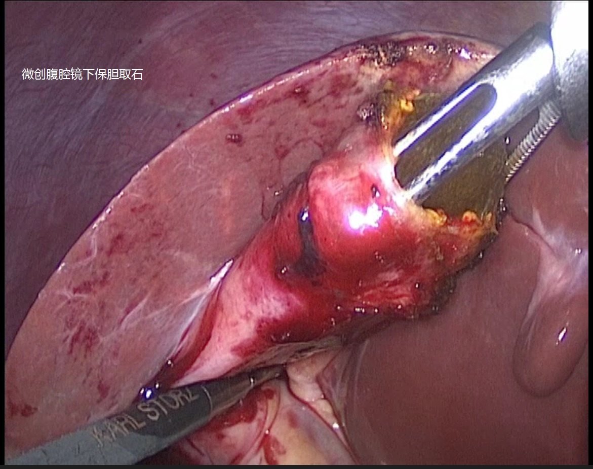 胆囊结石是否都需要手术切除什么情况适合保胆取石