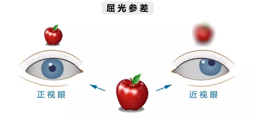 不容忽视的屈光参差 - 微医(挂号网)