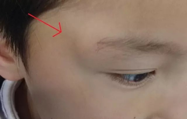 儿童常见的眼眶肿物表皮样囊肿