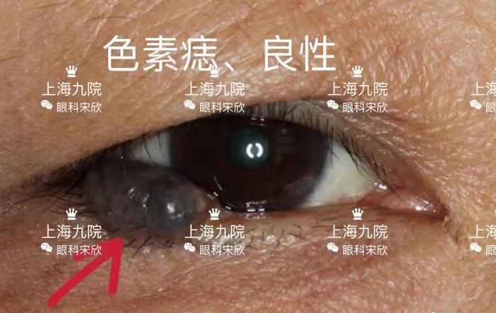 眼皮上奇奇怪怪的疙瘩都是什么常见眼睑肿瘤图片良恶性