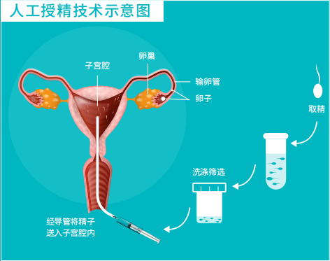 自己做人工授精成功图片