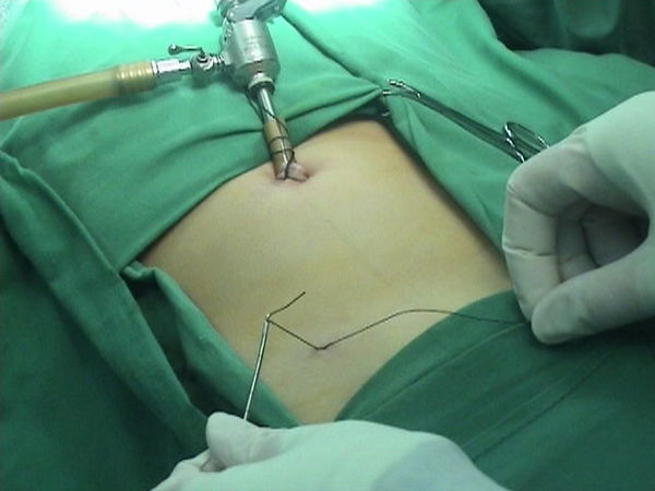 上图:这是我在单孔腹腔镜下治疗腹股沟斜疝,鞘膜积液的手术方法,手术