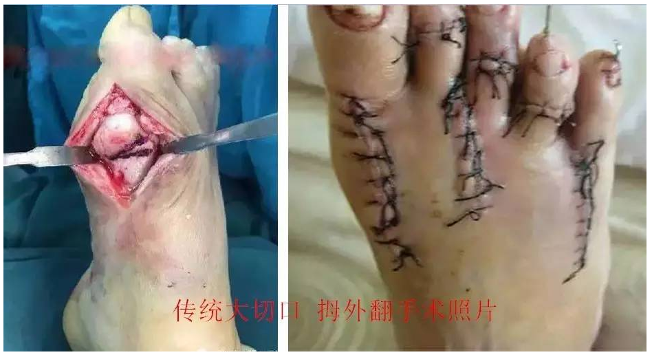 传统大切口手术中有140余种术式,医生可以选择适合患者的术式为患者