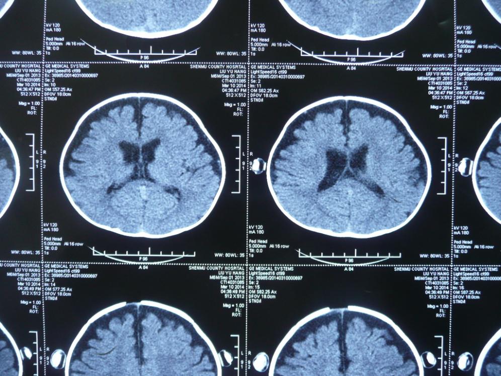 婴儿硬膜下积液莫要鲁莽手术