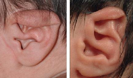 耳朵畸形有哪几种图片