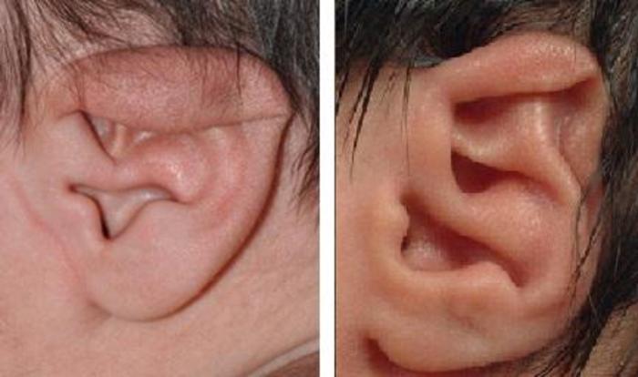 常见先天性耳廓畸形