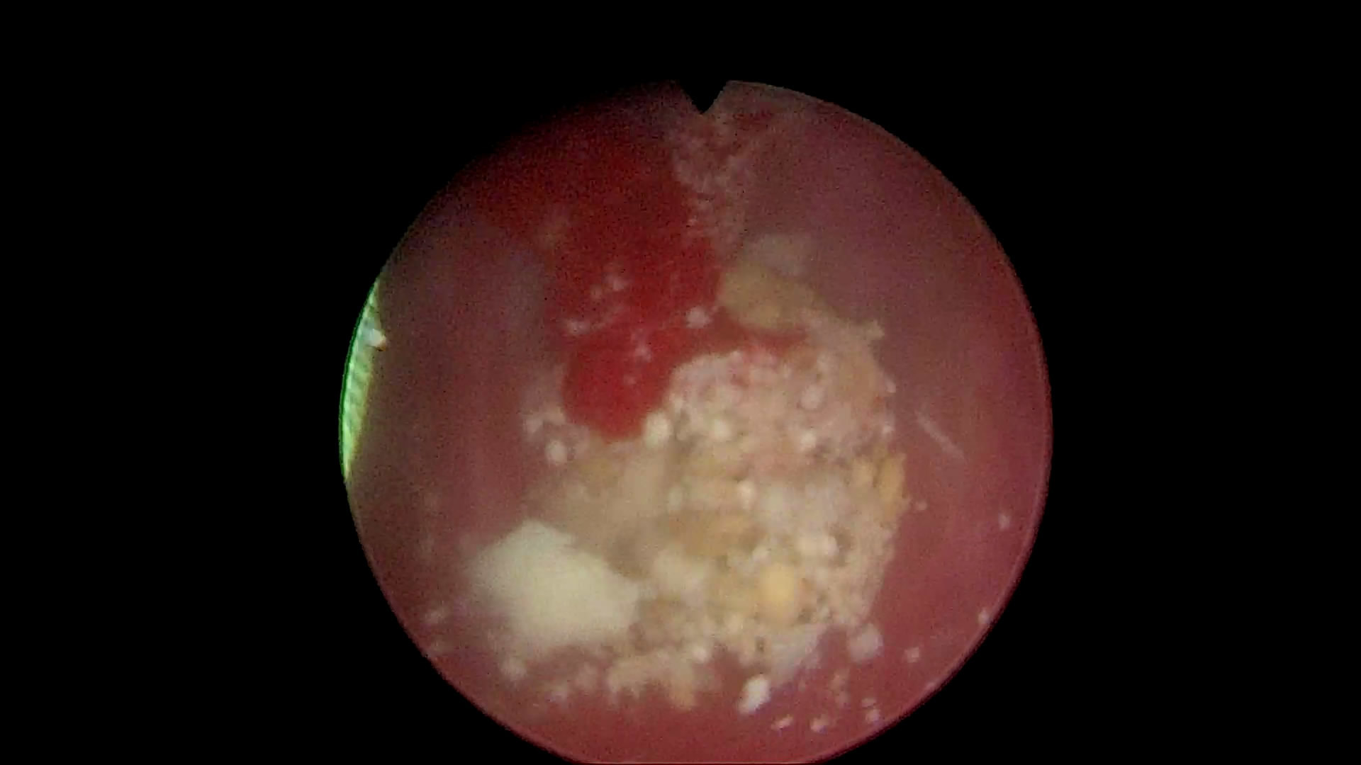 鹿角型肾结石的治疗