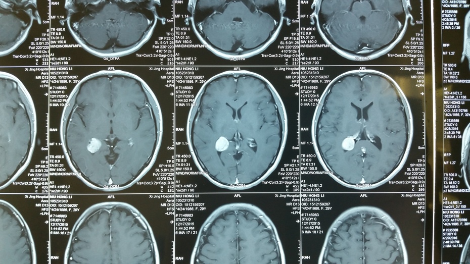 贺晓生教授侧脑室三角区脑膜瘤手术切除