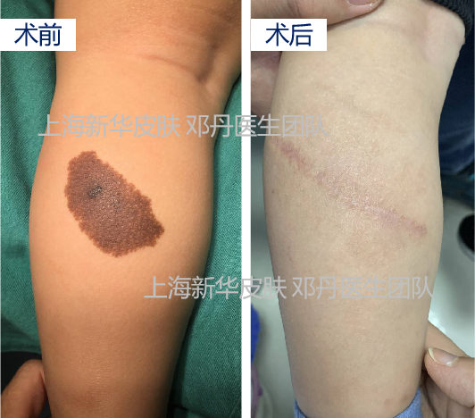 兽皮痣的手术治疗,也提及分次切除和植皮的不同选择