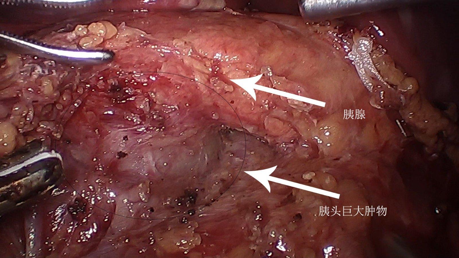 胰腺实性假乳头状瘤