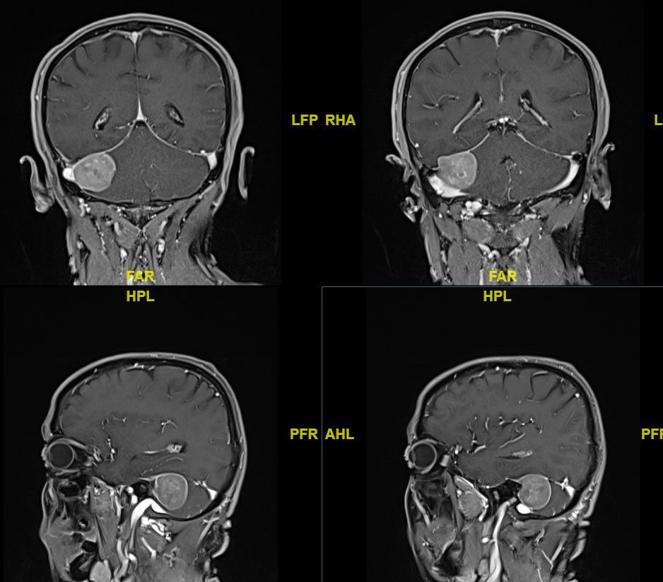 横窦乙状窦交界区天幕脑膜瘤手术病例 - 微医(挂号网)
