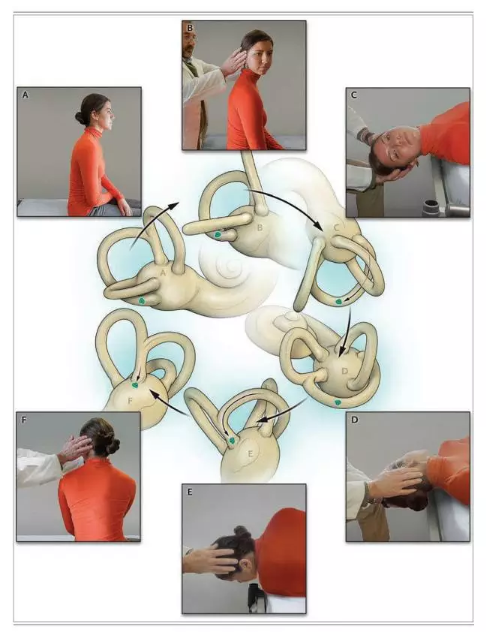 造成眩晕的主要疾病耳石症图片教你如何治疗