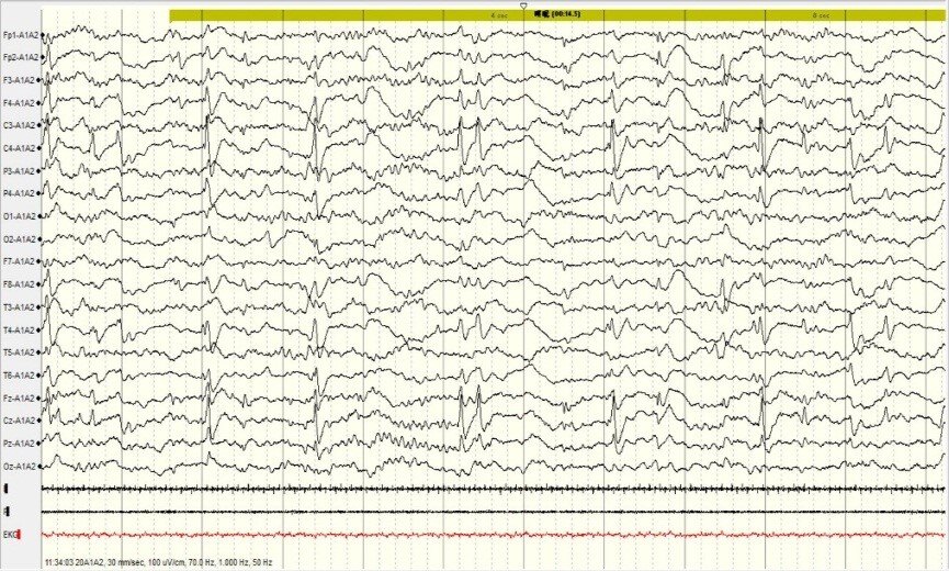 术后3周脑电图:持续放电有效终止,只在离断的患侧见有棘波,健侧的背景