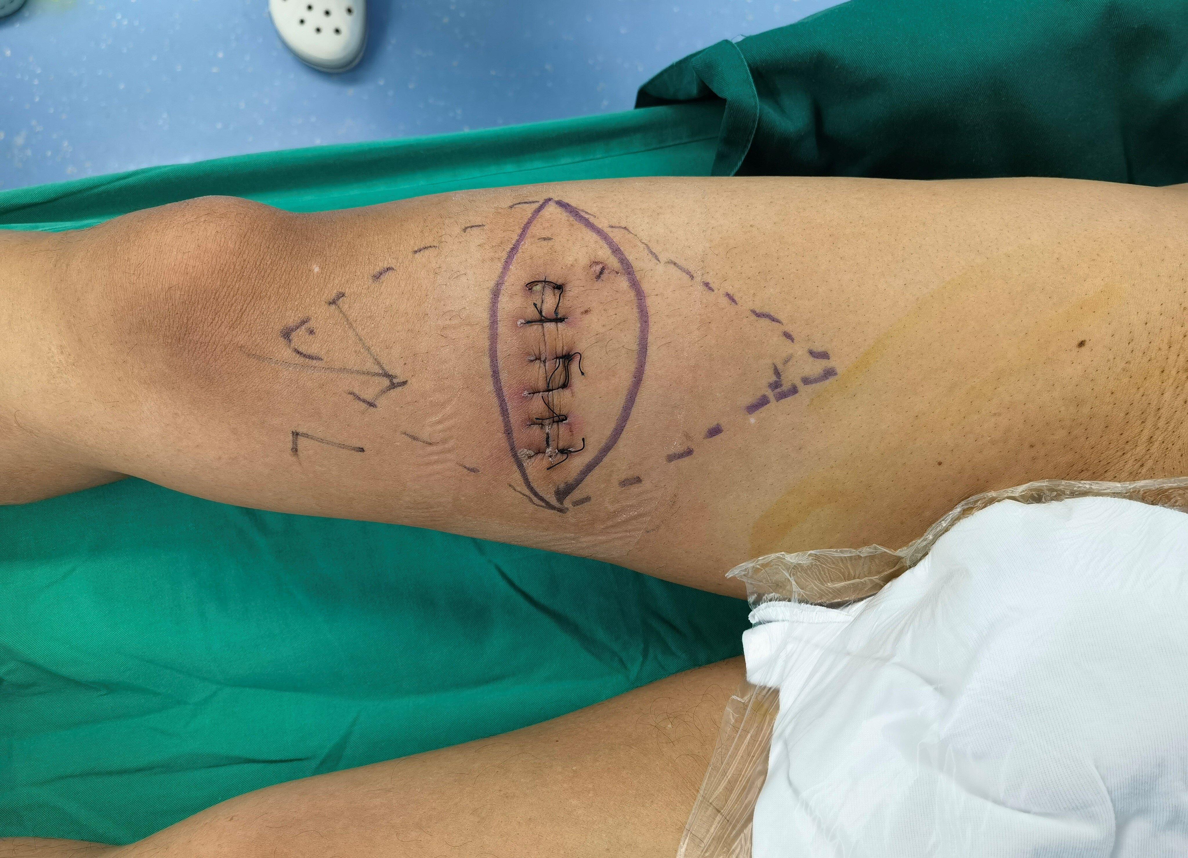 下肢软组织恶性肿瘤查体:右大腿中下段见一横行手术切口,长约10cm,对