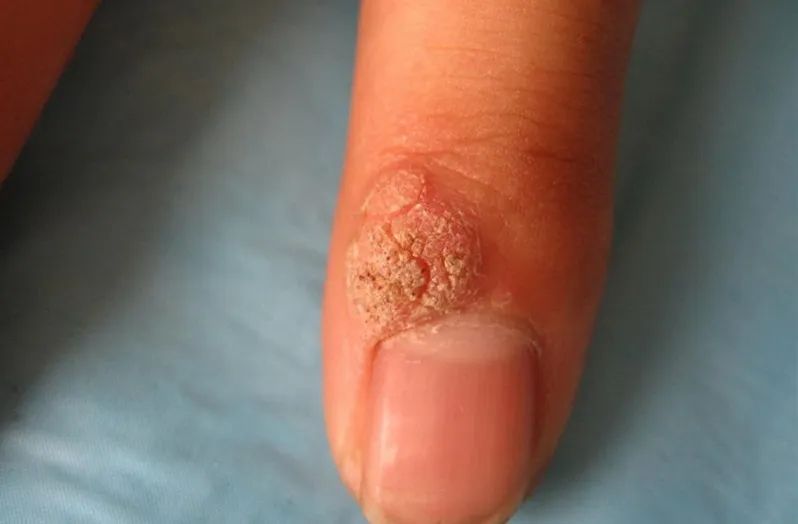 不痛不痒可憎可恶的瘊子疣