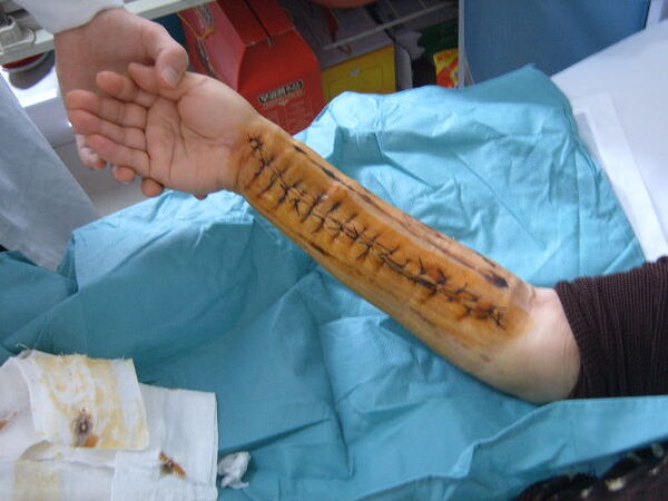 手术切除前臂复发巨大血管畸形