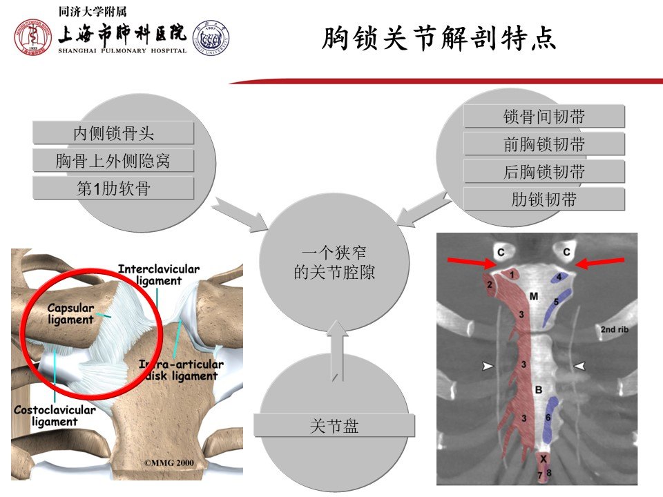 胸锁关节炎位置图片图片