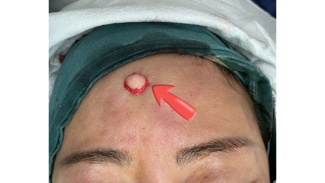 额部长了一个包应该怎么办