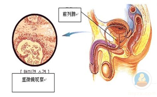 平時怎麼預防前列腺炎?