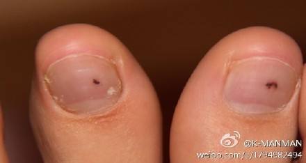 甲下变黑是恶性黑色素瘤吗