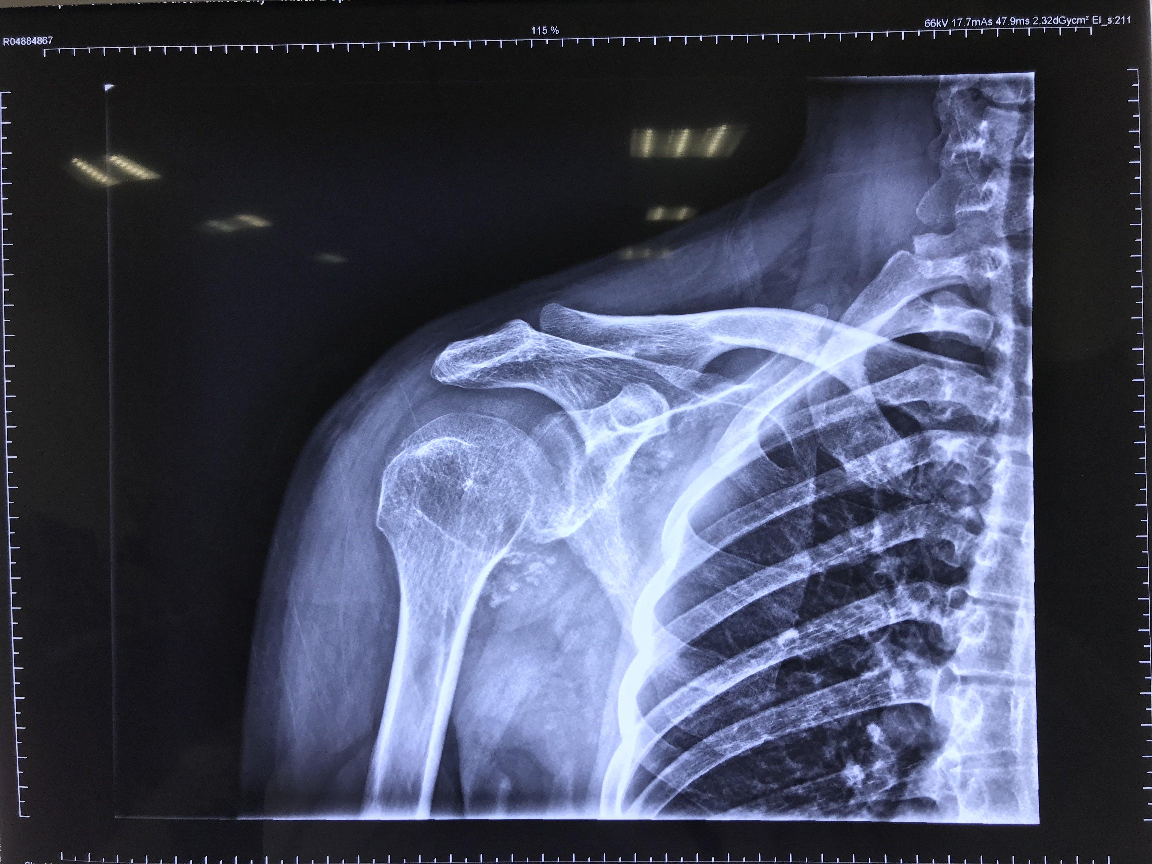 病例11 肱骨外科颈骨折(裂纹型)-特种医学-医学