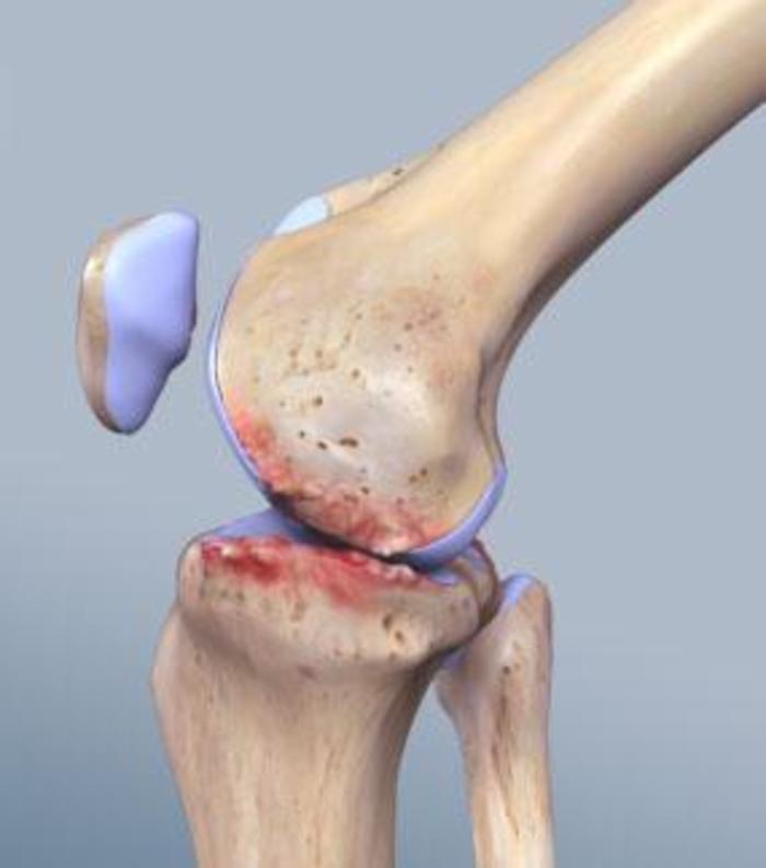 我的膝关节为什么会发响