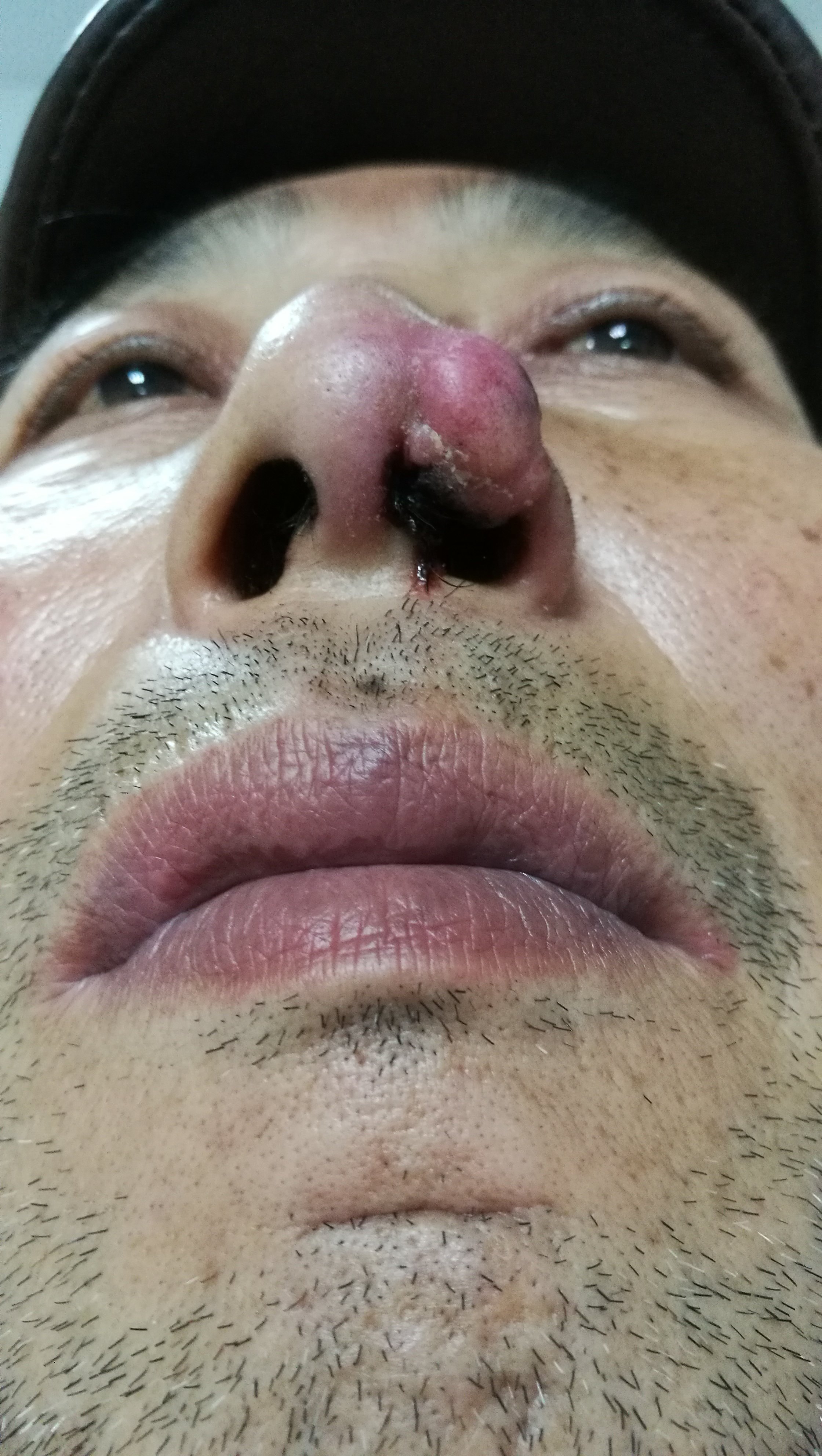 中老年外鼻面部丑陋的包块可能是皮肤恶性肿瘤图