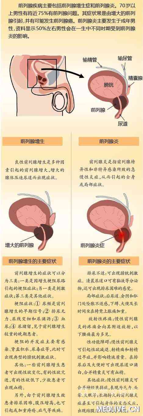 男性前列腺疾病与性功能障碍转