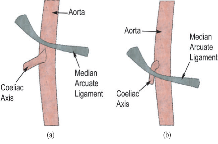 正中弓状韧带综合征手术治疗后长期症状改善