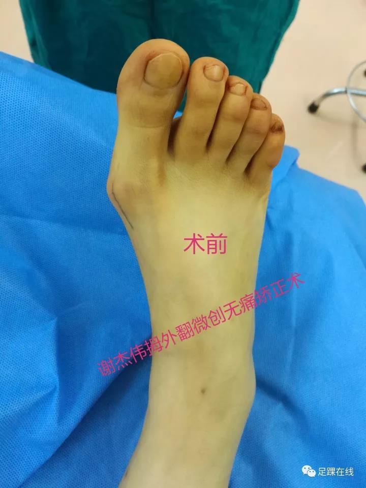 拇外翻(俗称大脚骨)的微创无痛美容矫正术