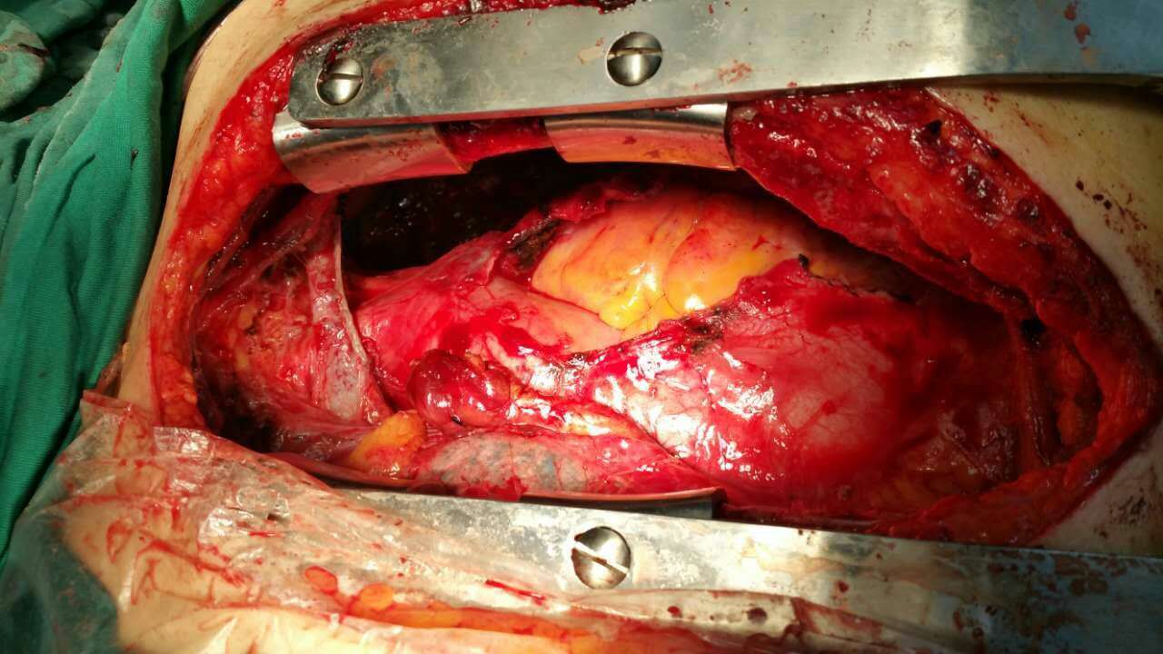 北京同仁医院胸外科勇于担当多次成功切除巨大胸腺瘤