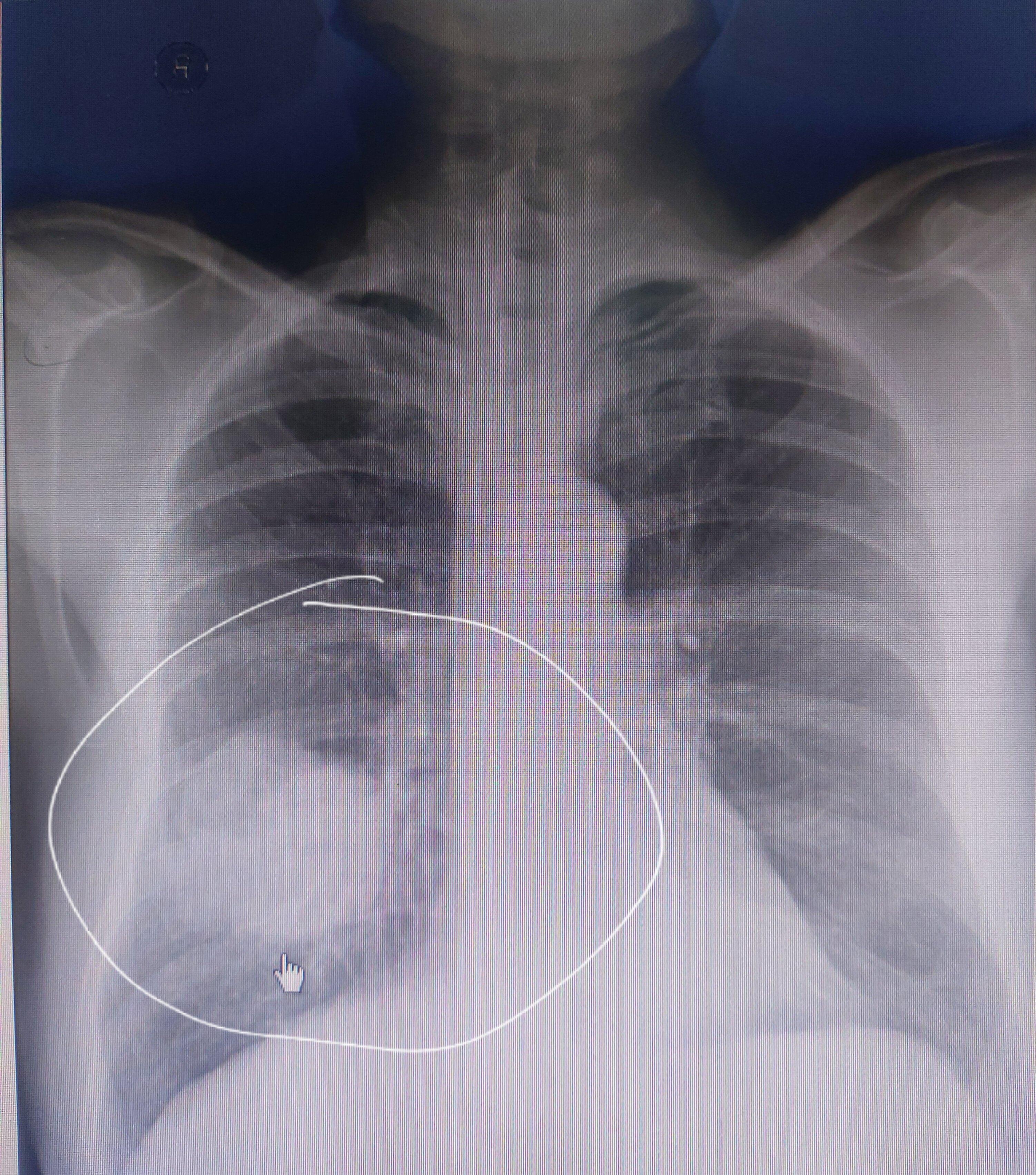 肺癌的片子图片图片