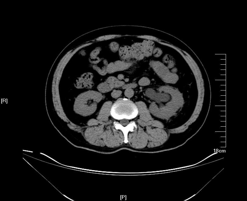 肾输尿管先天性畸形治疗的最新进展 - 微医(挂号网)