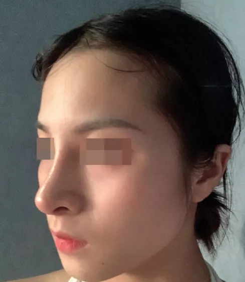 为什么假体隆鼻,高度不能随心所欲? - 微医(挂号网)