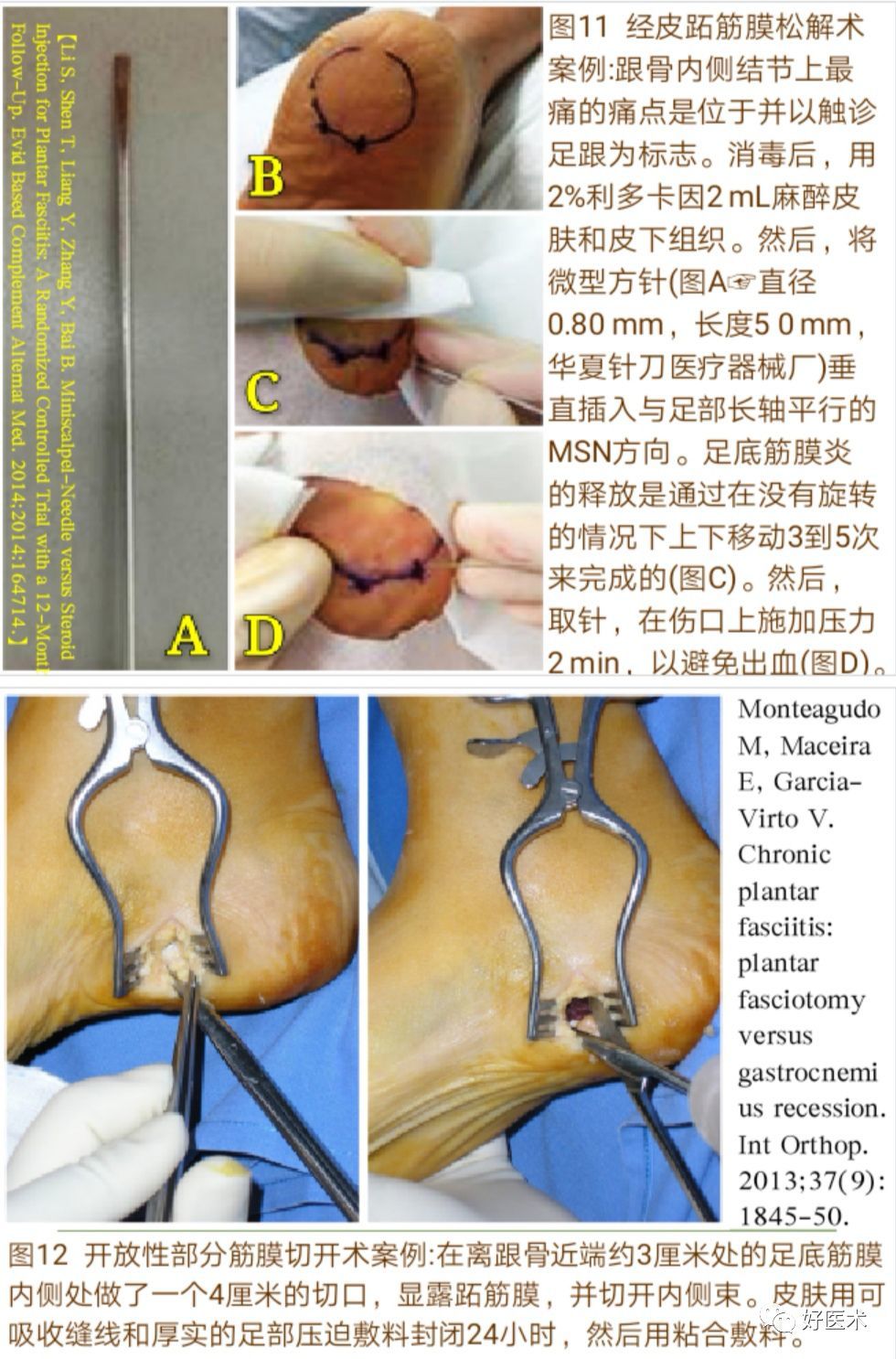 一文详解足底跖筋膜炎的诊治策略