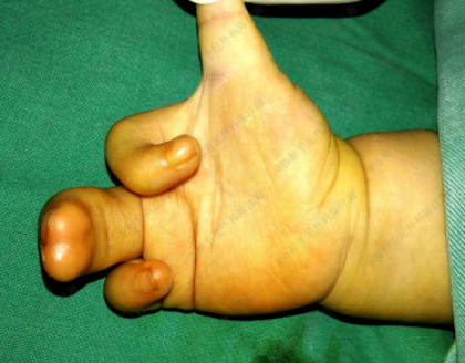 宝宝右手先天性并指畸形手术的时候要植皮吗可以不植皮吗