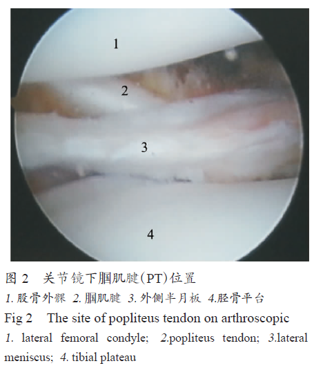 肌腱韧带损伤腘肌腱损伤易导致交叉韧带重建疗效不佳