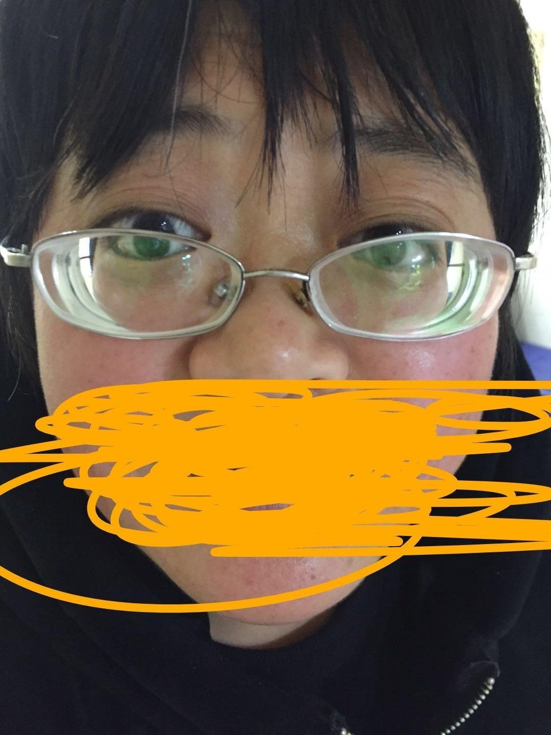 高度近视真的跟遗传有关吗图