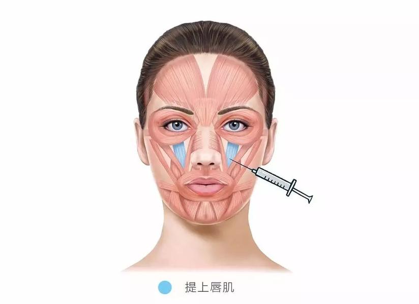 肉毒素小课堂 僵尸脸是怎么来的 健康号 微医