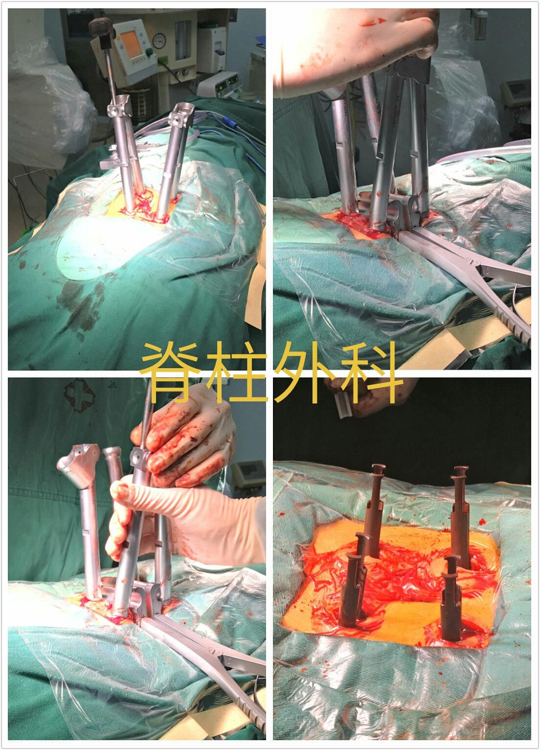 经皮置钉内固定术治疗胸腰椎爆裂性骨折病例分享