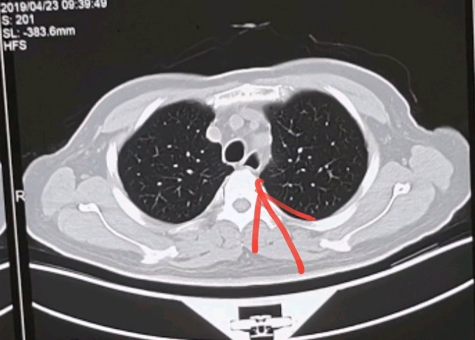 刘懿博士说肺癌一〇九九新长出来的气管憩室需要做