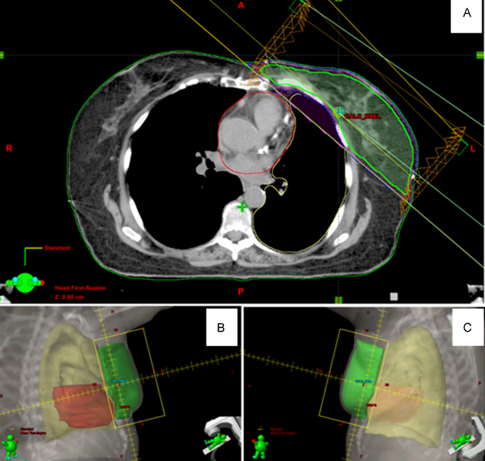 放疗丨乳腺癌放疗是怎么进行的