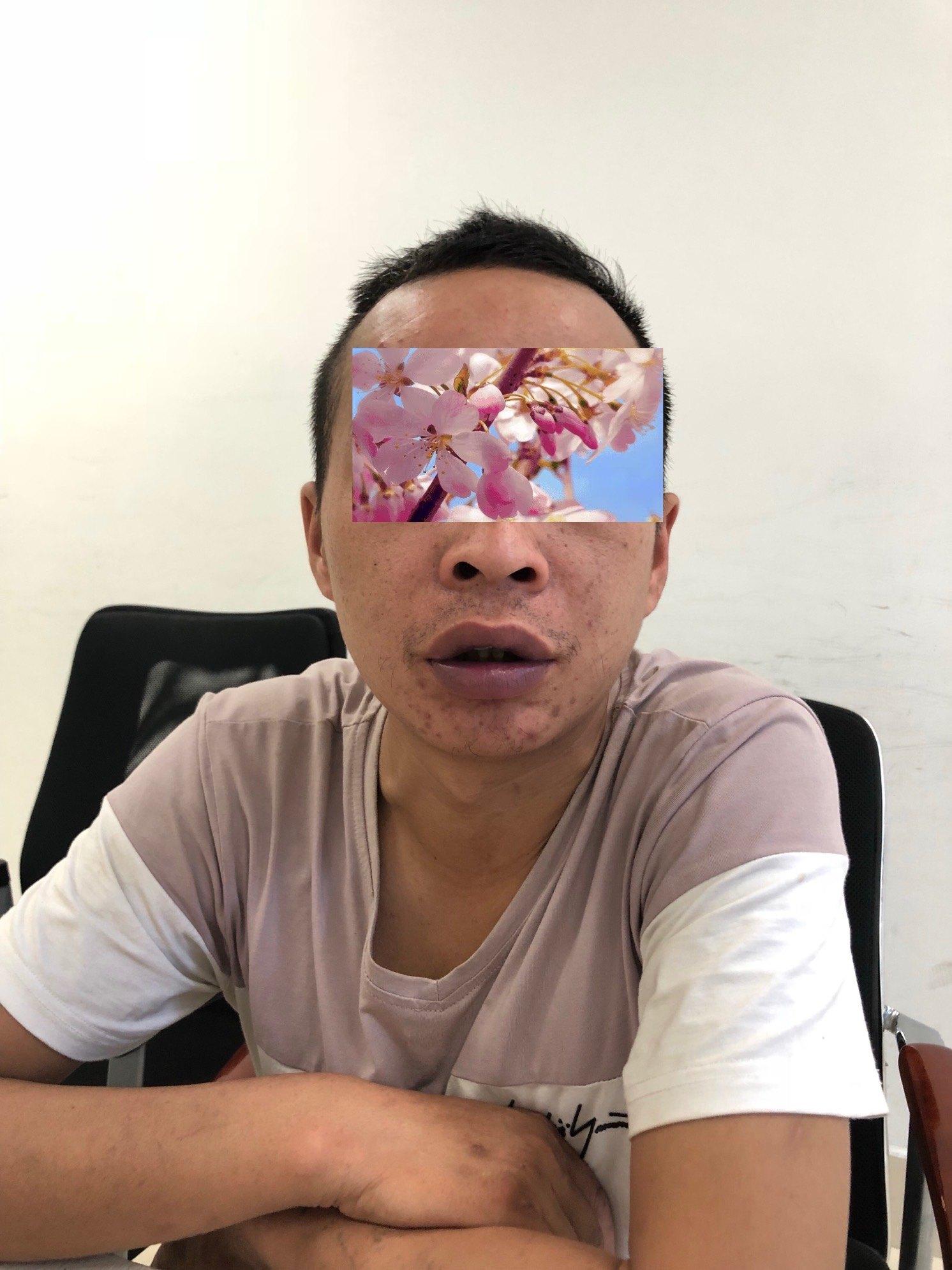 肺动脉高压关爱蓝嘴唇