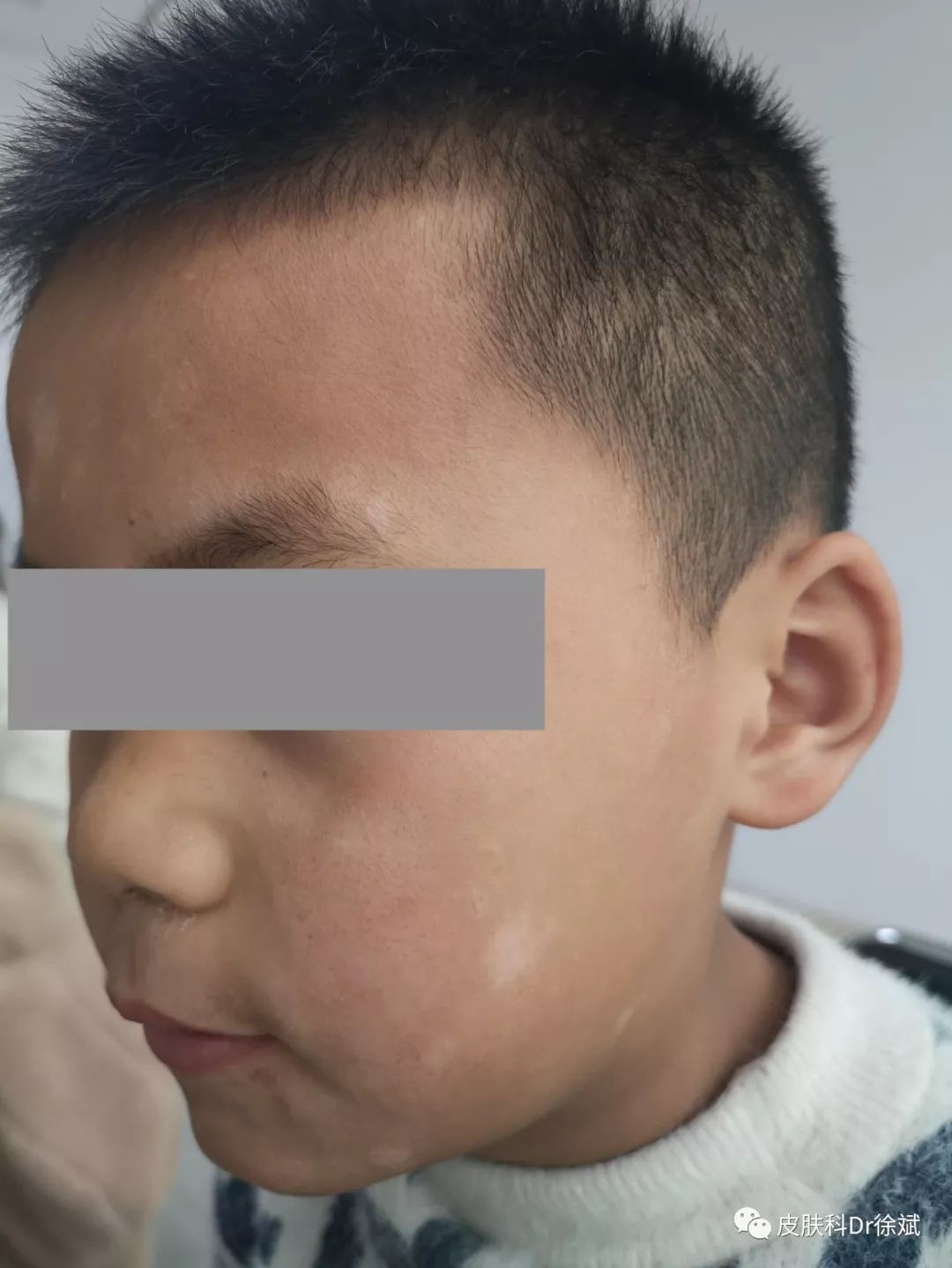 儿童面部白斑怎么办别慌可能和白癜风没有半毛钱关系
