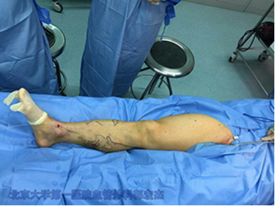 微创剥脱电凝怎么治好下肢静脉曲张