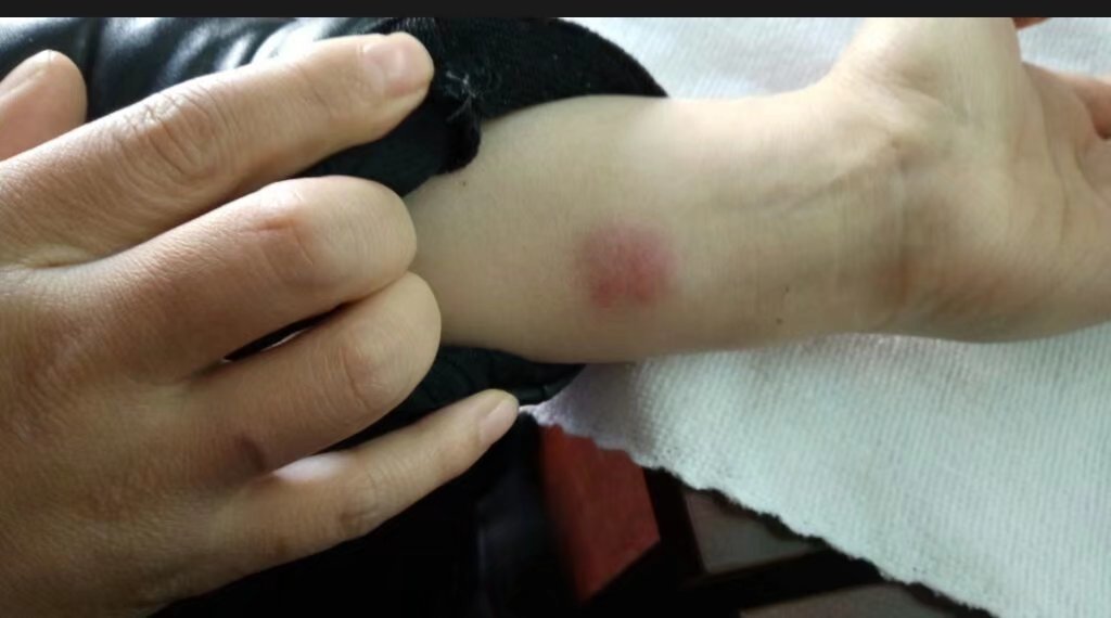 其患患心理结节阴影比其肺部结节阴影更具危害性