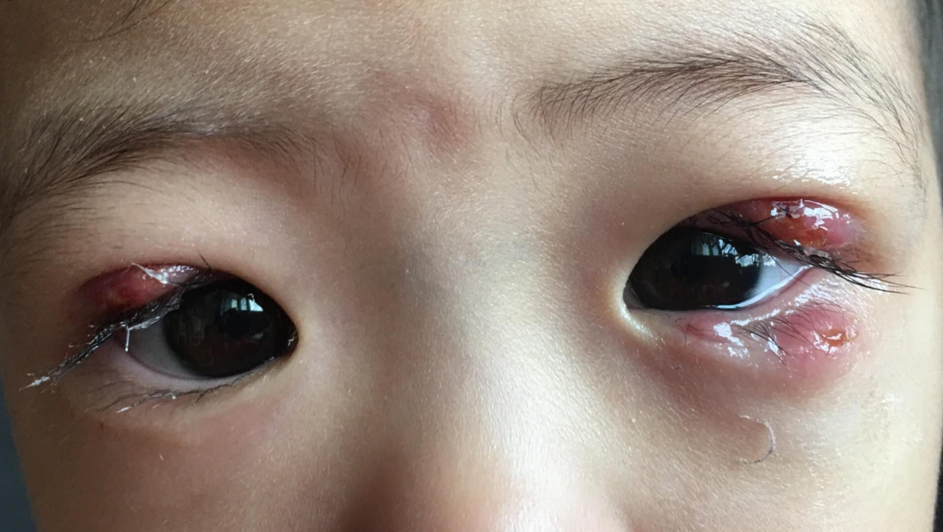 这些年,被家长耽误的霰粒肿 - 微医(挂号网)