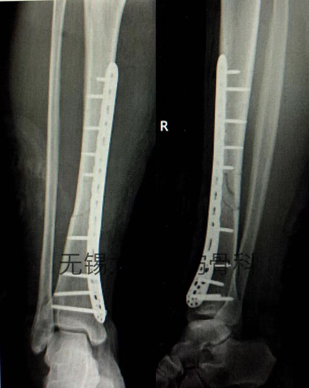 mipo技术微创治疗胫骨中下段骨折