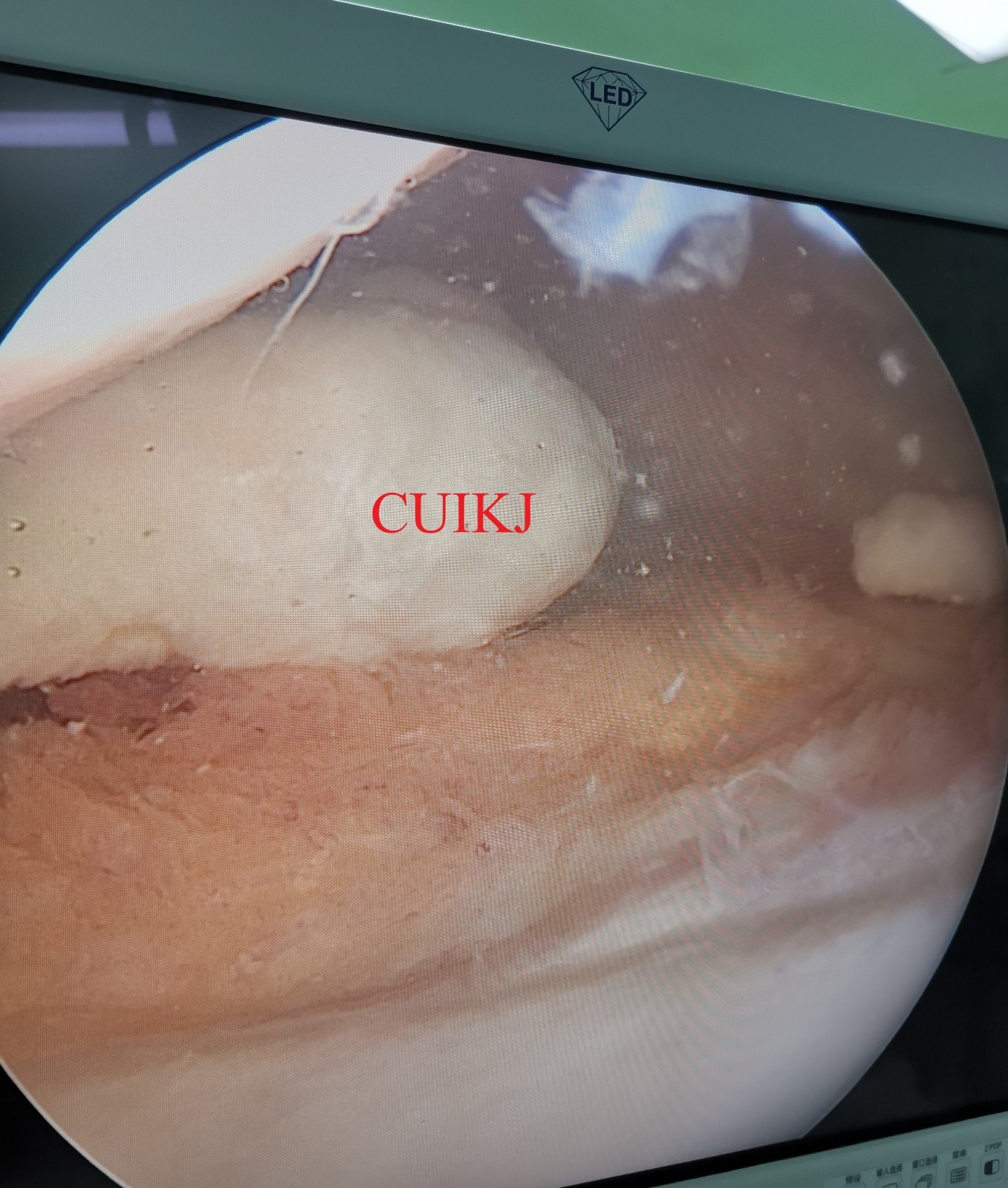 原创鼠年谈鼠骨哥崔大夫膝关节系列第二回关节鼠