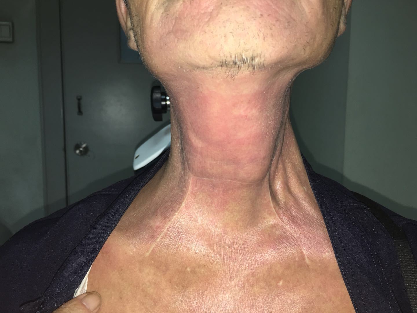 下咽癌诊治体会